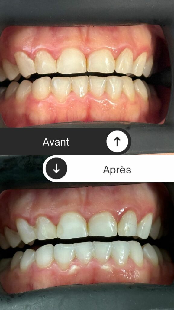 Résultat blanchiment dentaire Court-Saint-Etienne Brabant wallon